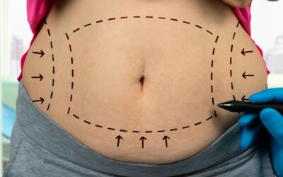 What are the Liposuction Side Effects?