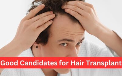 Good Candidates for Hair Transplant Surgery