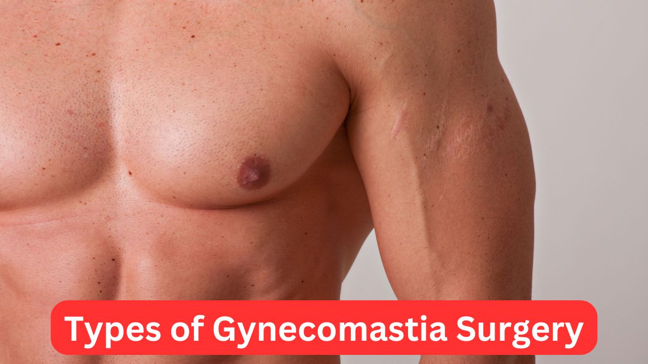 Types of Gynecomastia Surgery