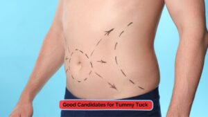 good candidate for Tummy Tuck