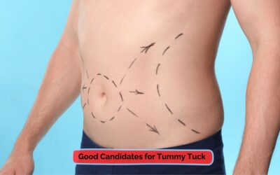 Are You a Good Candidate for Tummy Tuck?