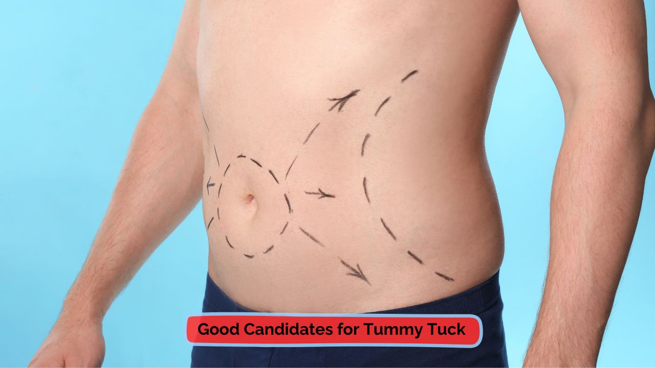 good candidate for Tummy Tuck