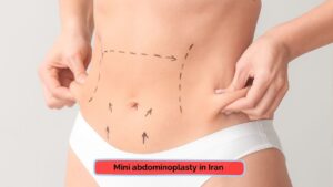 mini abdominoplasty in Iran