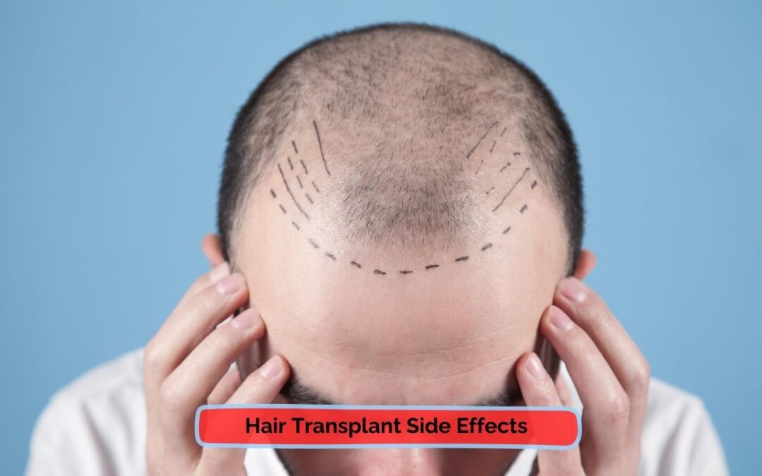 Hair Transplant Side Effects