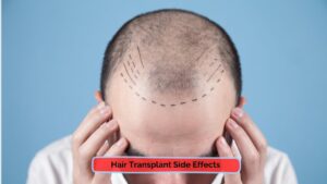 hair transplant side effects